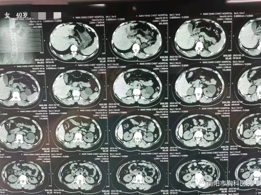 经腹腔镜左肾囊肿去顶减压术