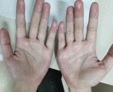 �������ж��Լ��ǲ����ֺ�֢��